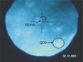 X-ray image of a stone and gas before treatment